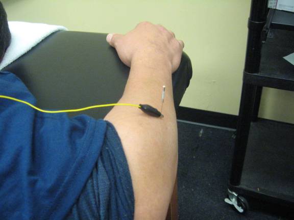 This is the entire process of pain relieving dry needling.