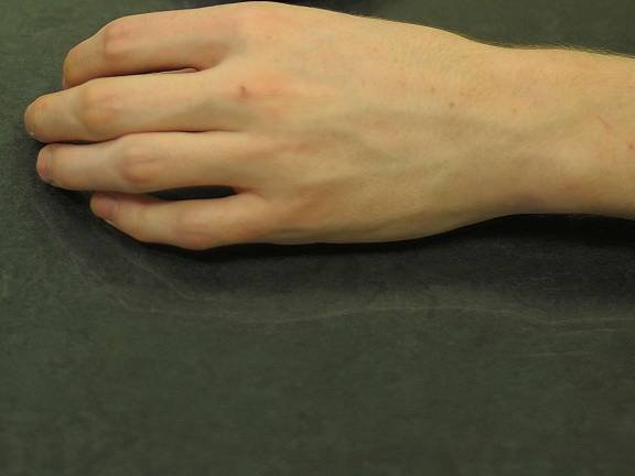 A recovering heroin addict, alias: &quot;Ben,&quot; shows his hand. Ben is now in his mid twenties he used the drug for roughly ten years.